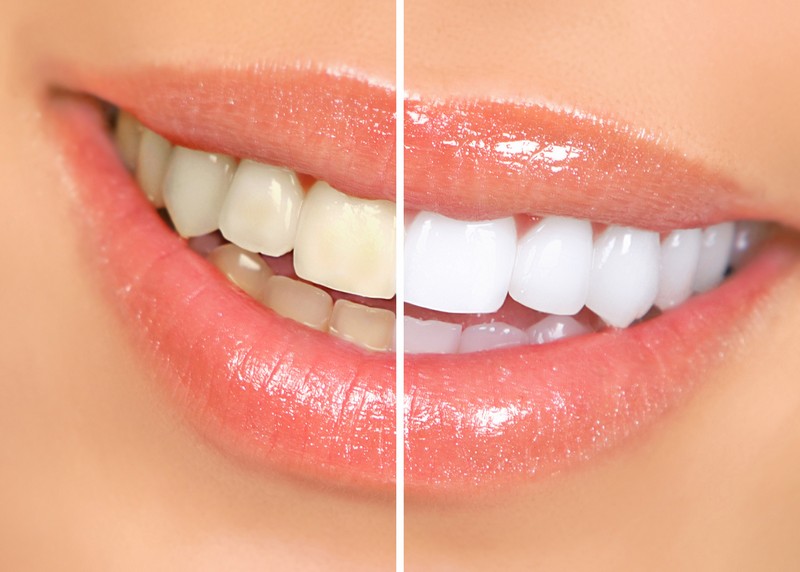 Teeth Whitening  Macclenny, FL 