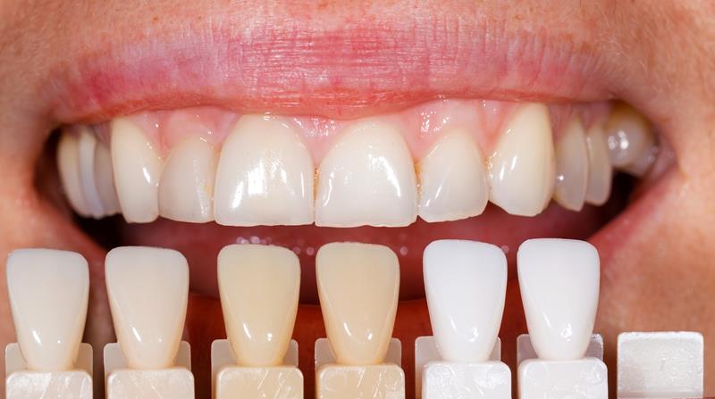 Veneers  Macclenny, FL 