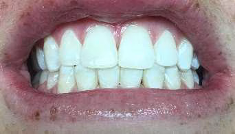 teeth whitening options  Macclenny, FL 